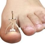 ingrown-toe-nail-correction-