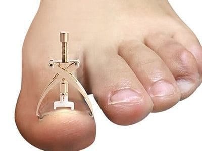 ingrown-toe-nail-correction-